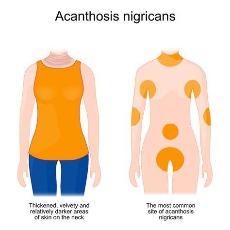 illustration acanthosis nigricans zones cutanées